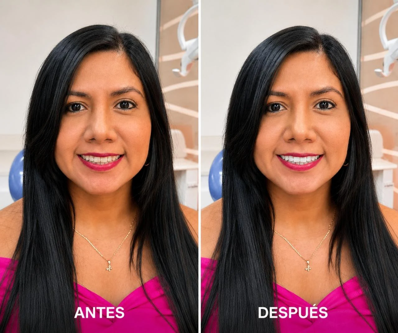 Registro fotográfico comparativo de una sonrisa, caso 2